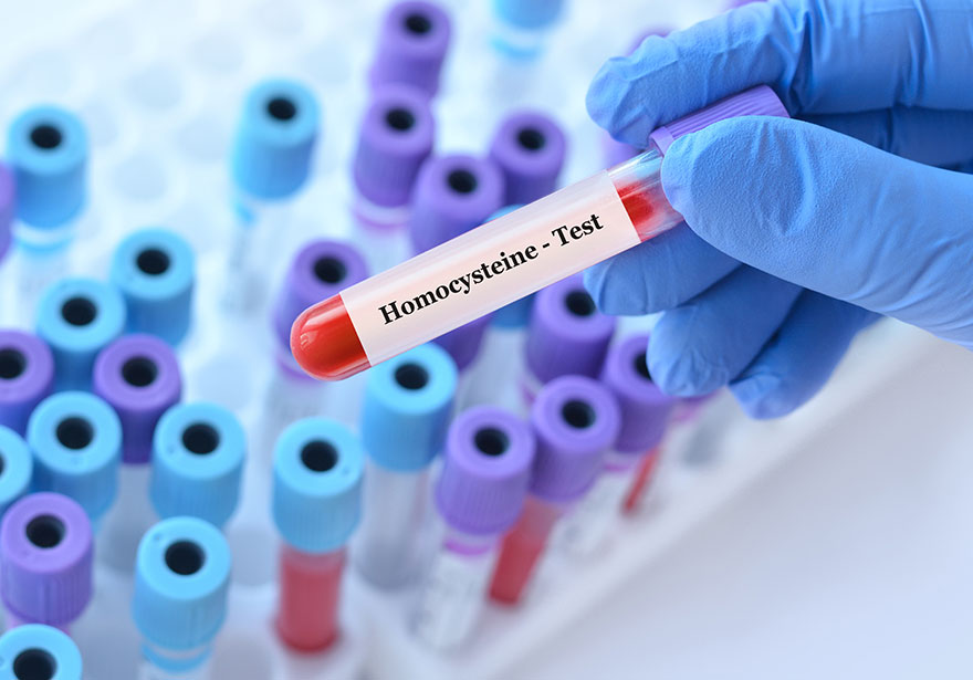 Homocysteina - co to takiego i jak ją obniżyć